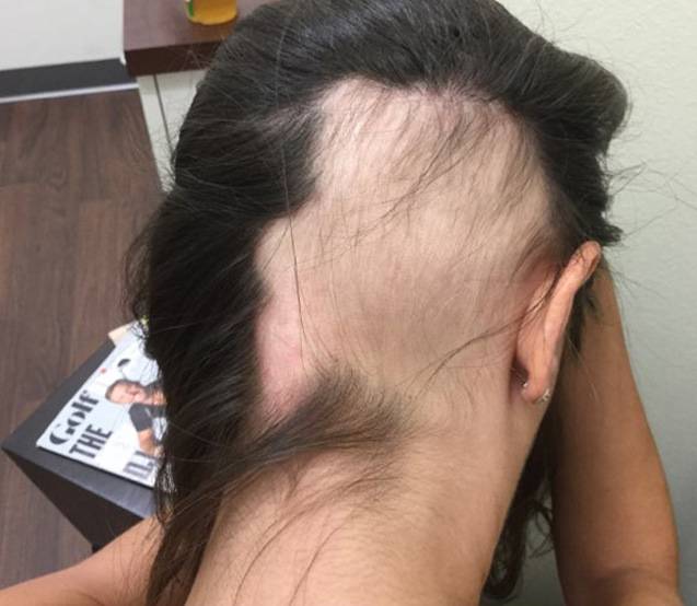 ProPlasma - Advanced PRP Hair Loss Treatment ProPlasma - Advanced PRP Hair Loss Treatment
