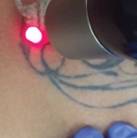 tattoo removal questions