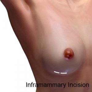 inframammary incision