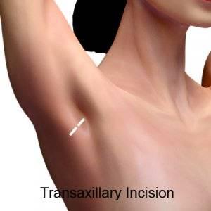 transaxillary incision