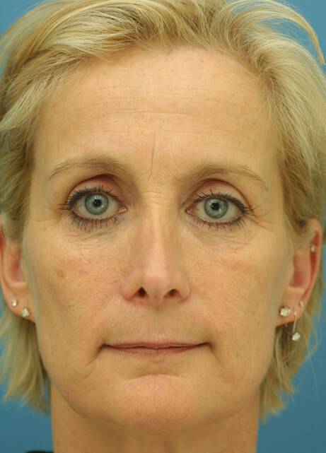 brow lift surgery in austin free consultation