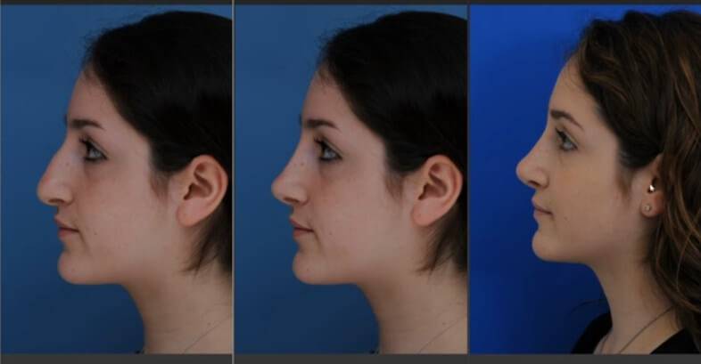 rhinoplasty imaging software