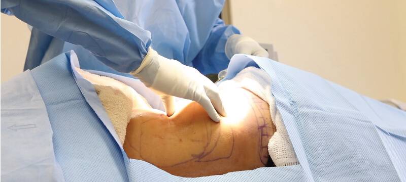 Liposuction Surgery