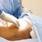 recovering from liposuction