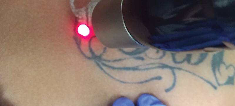 laser tattoo removal recovery