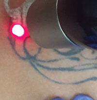 Laser Tattoo Removal Recovery: Tips + What to Expect Laser Tattoo Removal Recovery: Tips + What to Expect