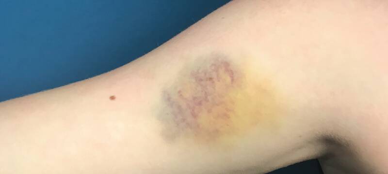 how to treat a bruise