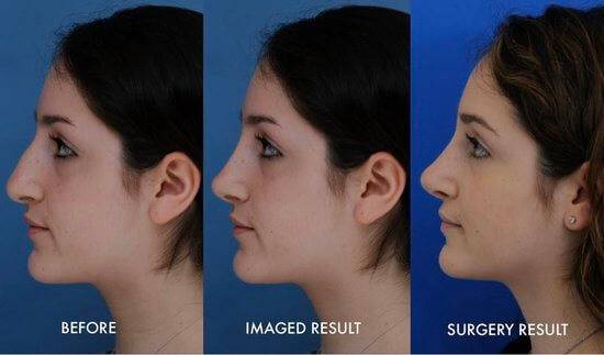 rhinoplasty imaging