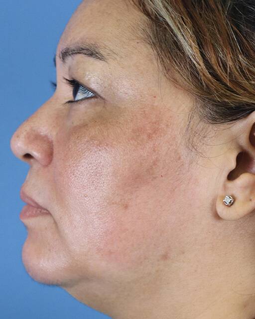 Skin Lightening System Westlake Dermatology Skin Lightening System Westlake Dermatology