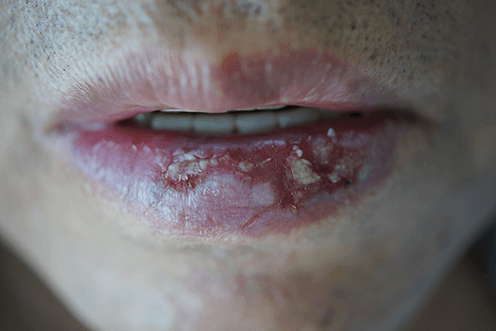 Actinic Cheilitis