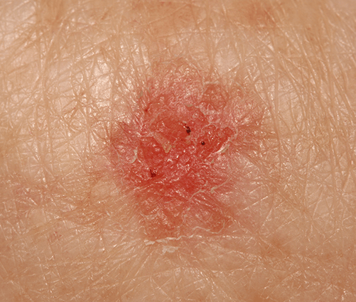 light-brown-scaly-spots-on-skin-infoupdate