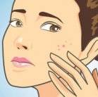 acne locations