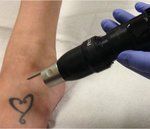 laser tattoo removal sessions