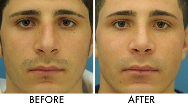 s-shaped nose correction
