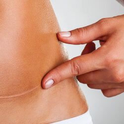 Will Tummy Tuck Surgery Leave Scars? - Westlake Dermatology