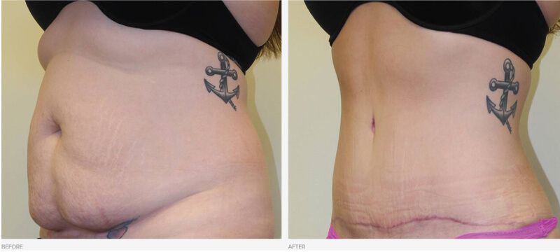 Tummy Tuck Before and After Photos - Dr Craig Rubinstein