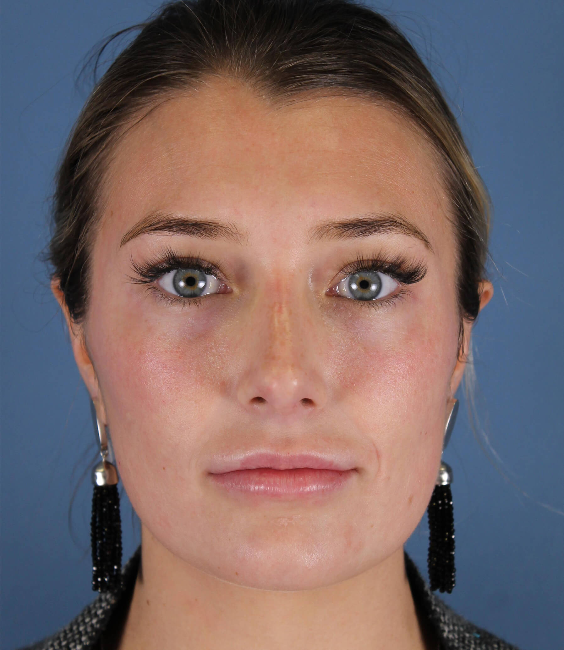#1 Botox Provider In Austin - Westlake Dermatology