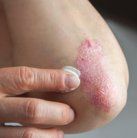 Psoriasis biologic treatments