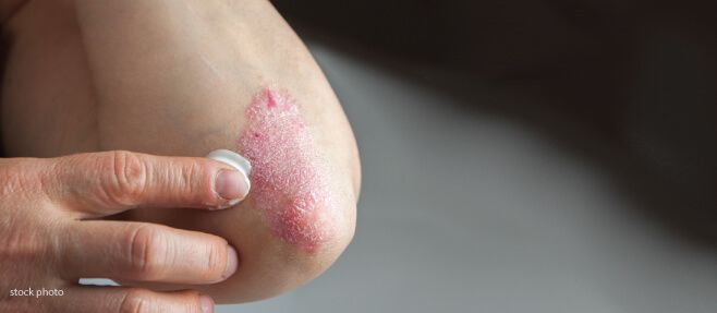 biologic treatments for psoriasis