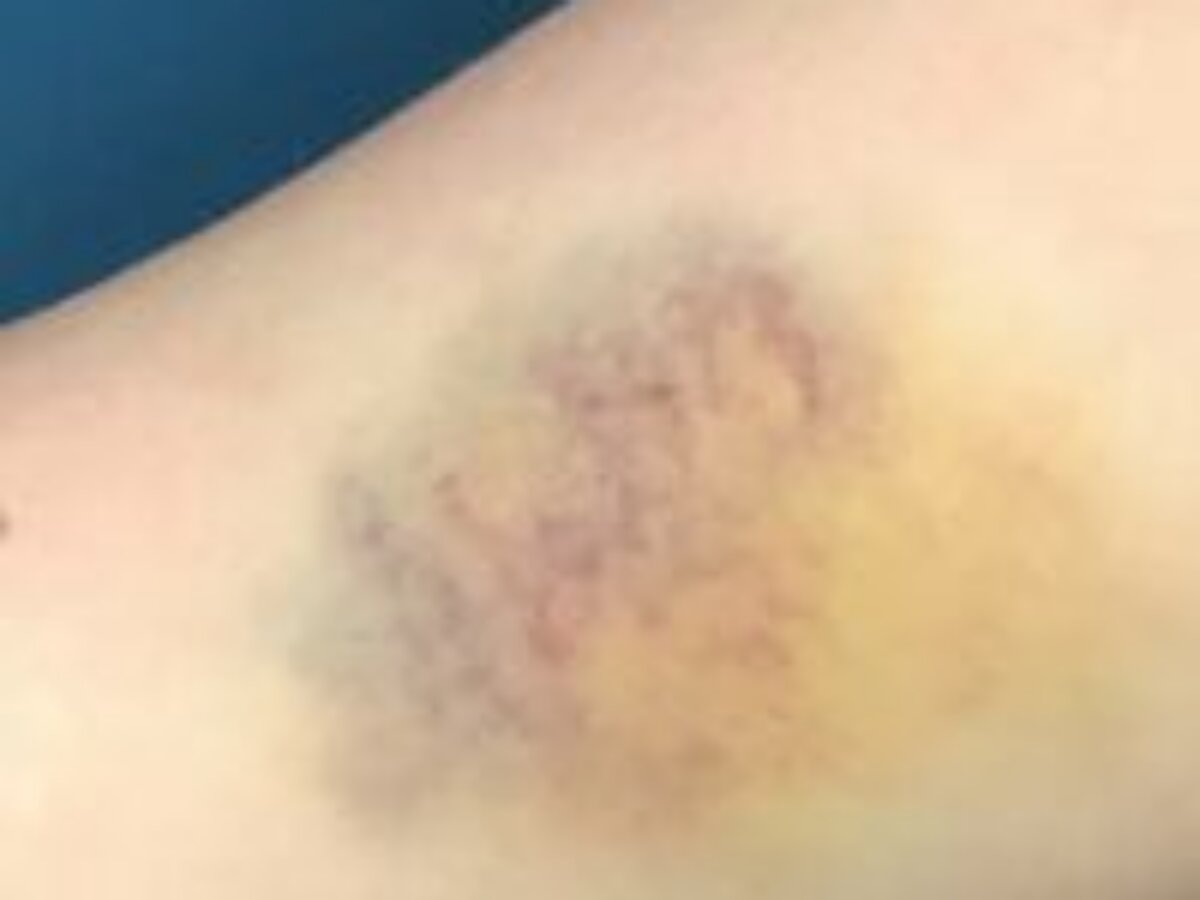 can b12 injections cause bruising Does therapy shot bruising? Common & Rare Side Effects