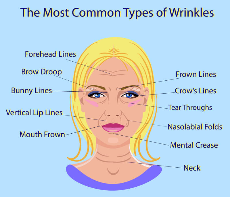 common types of wrinkles