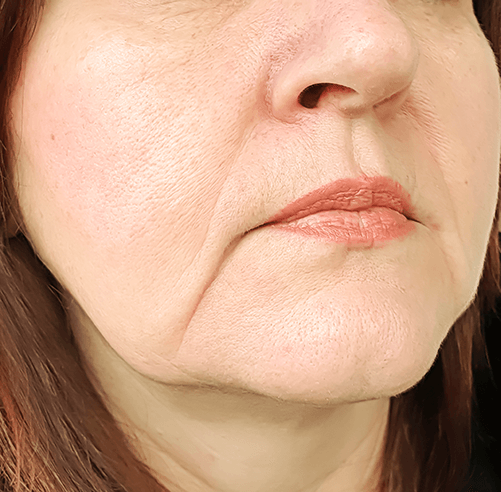 Lines and Wrinkles on the Upper Lip and Around the Mouth Explained – Caci