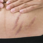 stretch marks