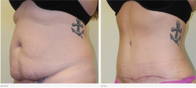 tummy tuck myths