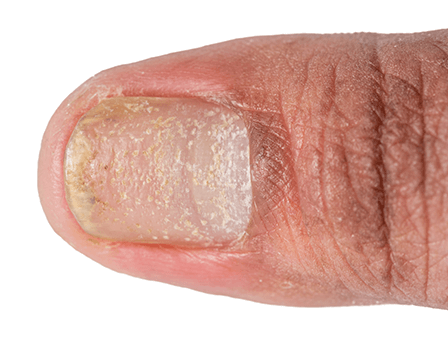 nail psoriasis close up