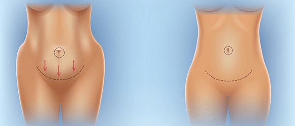 mini tummy tuck diagram