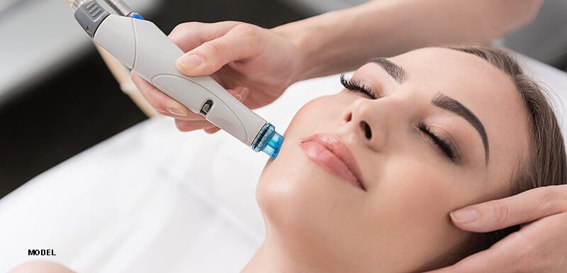 rosacea laser