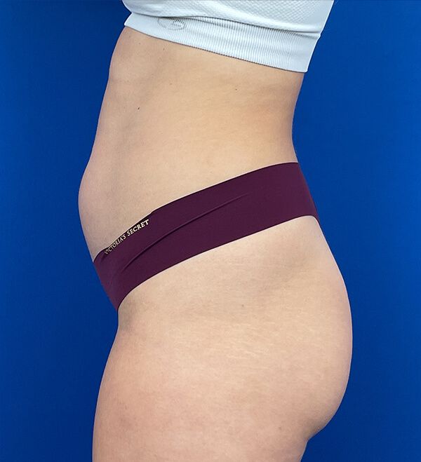 Liposuction vs. Tummy Tuck Surgery - What's The Difference?