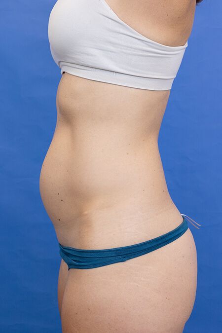 Abdominal Liposuction vs. Tummy Tuck - Fort Worth, TX