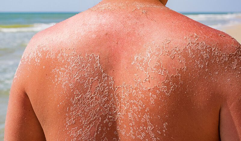 skin peeling sun burn