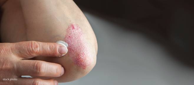 Psoriasis treatment options