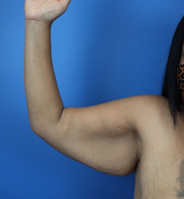 Austin Arm Lift Surgery Free Consultations (512) 328 3376