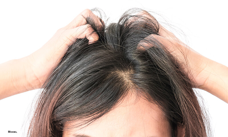 Seborrheic Dermatitis scalp