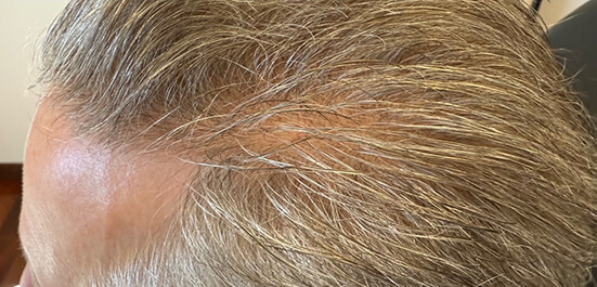 Pdgf Skin Before & After Ariessence Pure PDGF+ Hair Injections: Case 301784