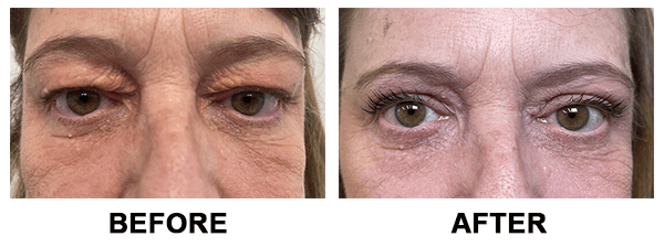 xanthelasma before and after case
