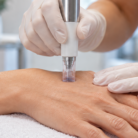 thumbnail close up of woman hand microneedling