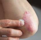 psoriasis