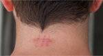 scar removal